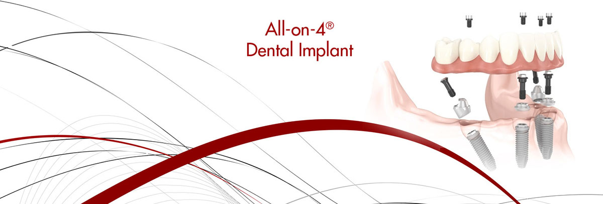 Warren All-on-4 Dental Implants