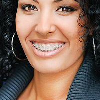 Clear Braces