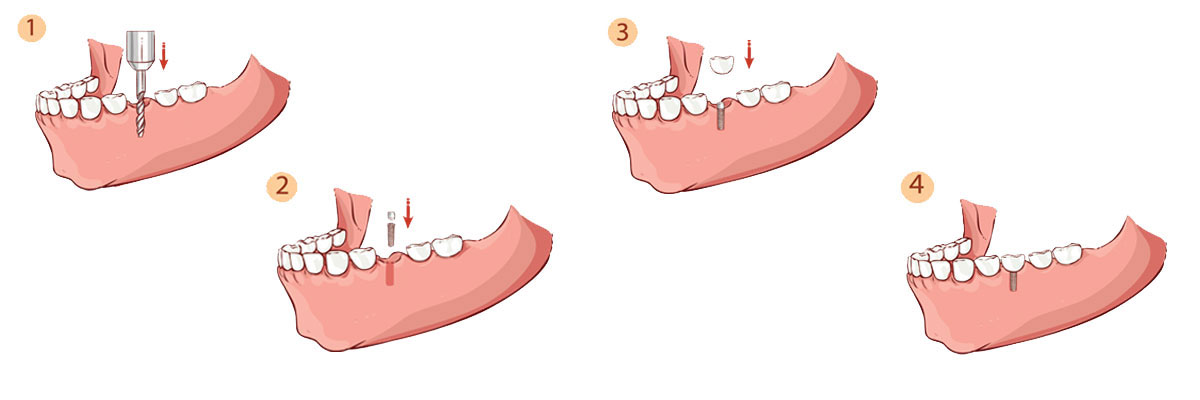 Warren Dental Implant Restoration