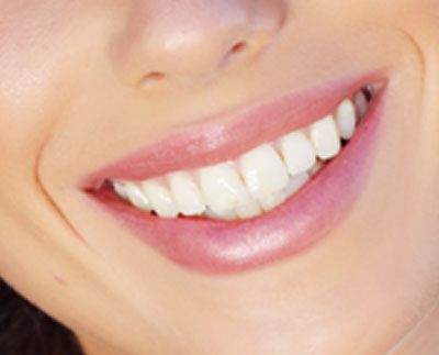 What Is Gum Contouring and Reshaping