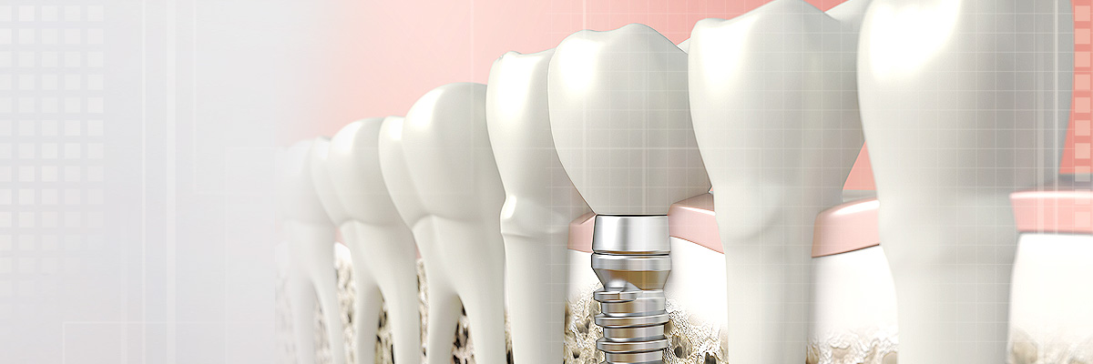 Warren Implant Dentist