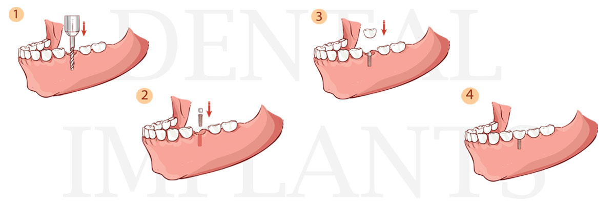 Warren The Difference Between Dental Implants and Mini Dental Implants