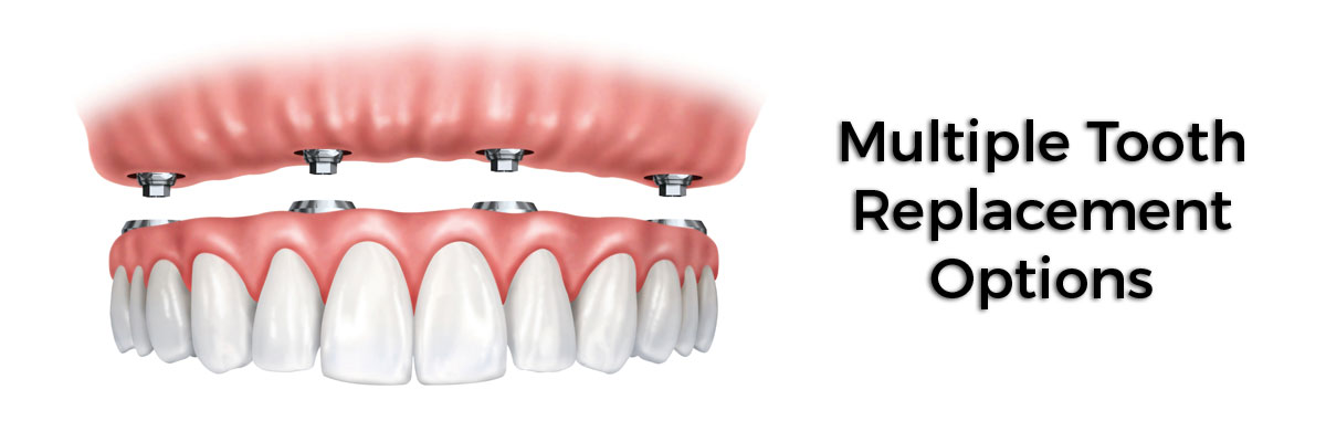 Warren Multiple Teeth Replacement Options