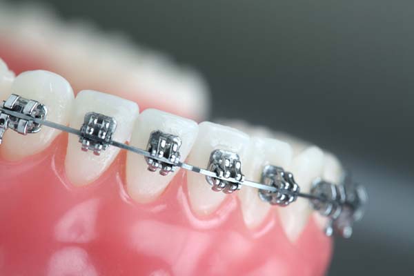 Orthodontics Warren, OH