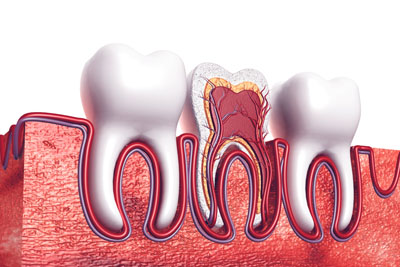 Root Canal Treatment